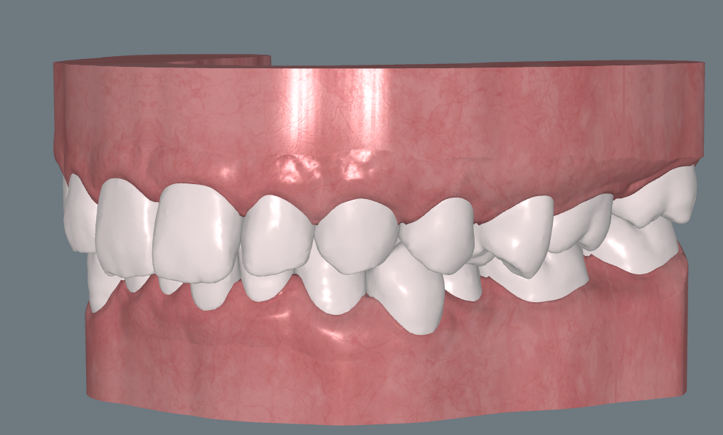 Anterior Bite Ramps – CandidPro