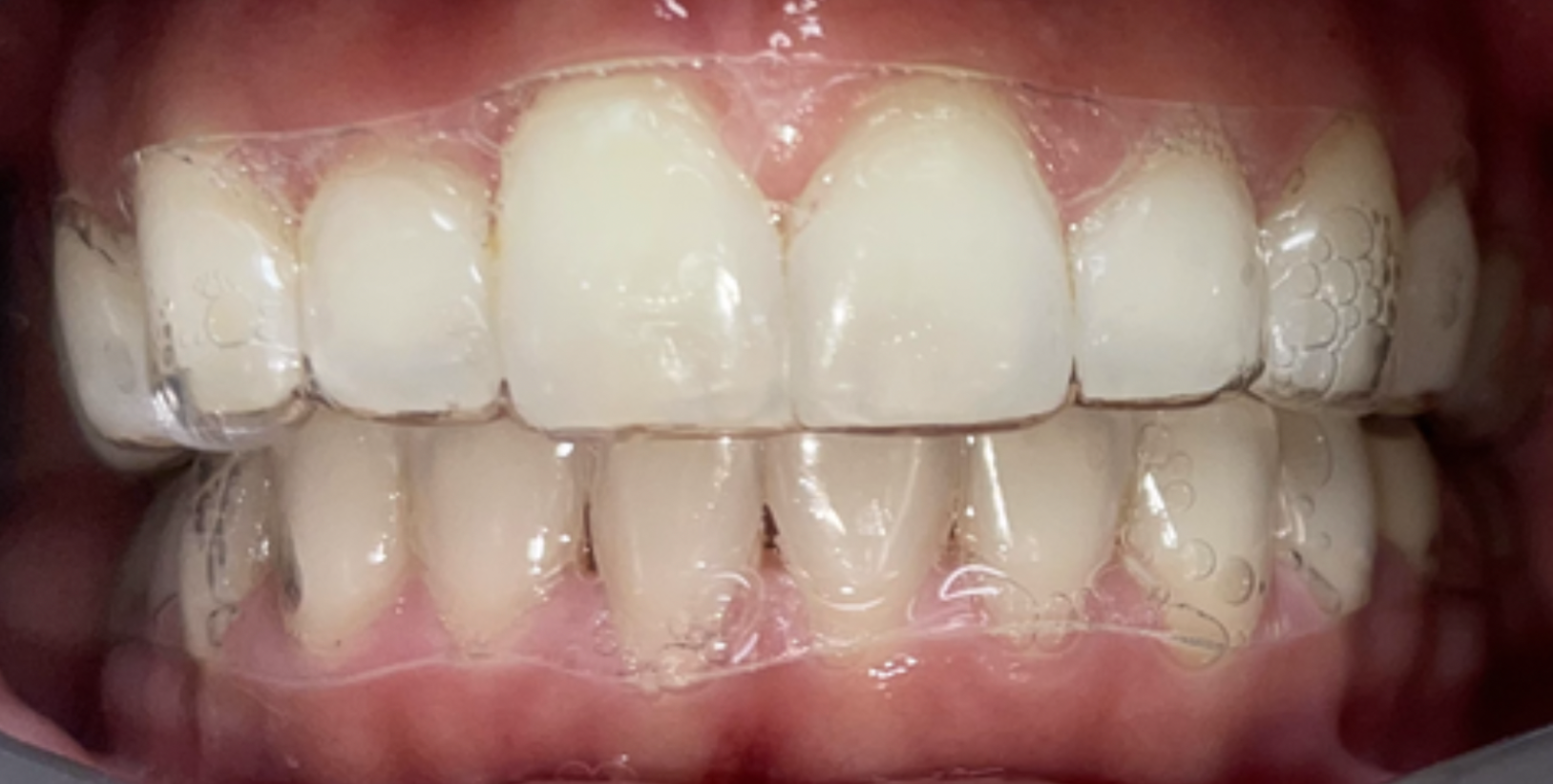 Horizontal Aligner Trims – CandidPro