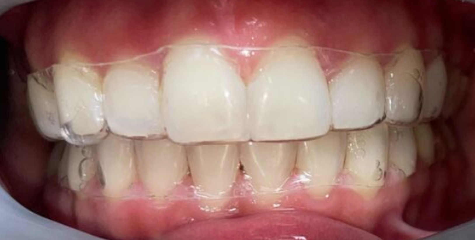 Horizontal Aligner Trims – CandidPro